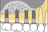 Elevación de seno maxilar